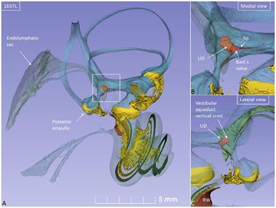 A Synchrotron and Micro-CT Study of the Human Endolymphatic Duct System: Is Meniere's Disease Caused by an Acute Endolymph Backflow?